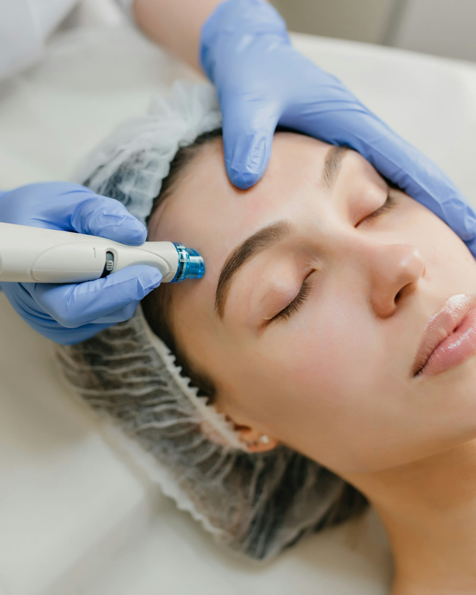 Dermapen (Mikroiğneleme)